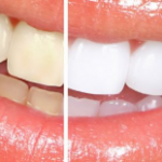 Clareamento Dentário